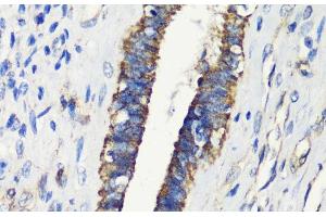Immunohistochemistry of paraffin-embedded Human uterine cancer using FKBP1A Polyclonal Antibody at dilution of 1:200 (40x lens).