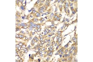 Immunohistochemistry of paraffin-embedded human esophageal cancer using VTI1B antibody (ABIN6132781, ABIN6150162, ABIN6150163 and ABIN6222854) at dilution of 1:100 (40x lens). (VTI1B antibody  (AA 1-210))