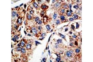 IHC analysis of FFPE human hepatocarcinoma tissue stained with the KMT4 antibody (DOT1L antibody  (AA 1390-1420))