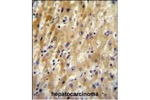 HABP2 Antibody (C-term) (ABIN651853 and ABIN2840423) immunohistochemistry analysis in formalin fixed and paraffin embedded human hepatocarcinoma followed by peroxidase conjugation of the secondary antibody and DAB staining. (HABP2 antibody  (C-Term))
