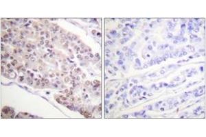 Immunohistochemistry analysis of paraffin-embedded human breast carcinoma tissue, using Histone H4 (Acetyl-Lys8) Antibody. (Histone H4 antibody  (acLys8))