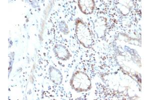 Formalin-fixed, paraffin-embedded human Colon Carcinoma stained with RAD51 Mouse Monoclonal Antibody (RAD51/2702). (RAD51 antibody  (AA 1-134))