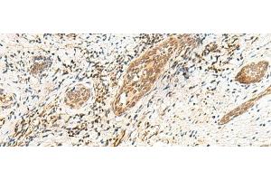 Immunohistochemistry of paraffin-embedded Human esophagus cancer tissue using POLR1D Polyclonal Antibody at dilution of 1:50(x200) (POLR1D antibody)