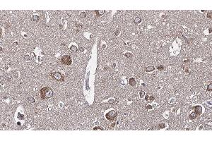 ABIN6277649 at 1/100 staining Human brain cancer tissue by IHC-P. (WNK3 antibody  (C-Term))