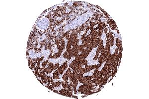 Pancreatic neuroendocrine tumor insulinoma with strong Insulin positivity of most tumor cells