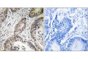 Immunohistochemistry analysis of paraffin-embedded human colon carcinoma, using TUT1 Antibody. (TUT1 antibody  (AA 291-340))