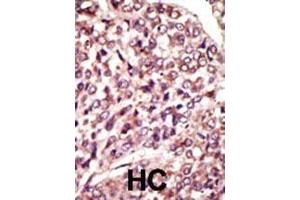Formalin-fixed and paraffin-embedded human cancer tissue reacted with the primary antibody, which was peroxidase-conjugated to the secondary antibody, followed by AEC staining. (MGAT1 antibody  (C-Term))