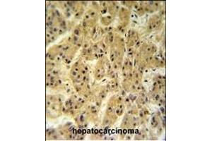 SC24A Antibody (Center) (ABIN650899 and ABIN2839987) IHC analysis in formalin fixed and paraffin embedded hepatocarcinoma followed by peroxidase conjugation of the secondary antibody and DAB staining. (SEC24A antibody  (AA 636-663))