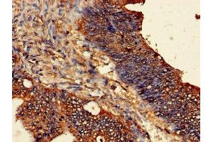 Immunohistochemistry of paraffin-embedded human colon cancer using ABIN7162297 at dilution of 1:100 (ODC1 antibody  (AA 1-461))