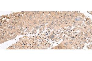 Immunohistochemistry of paraffin-embedded Human cervical cancer tissue using PATJ Polyclonal Antibody at dilution of 1:45(x200) (PATJ antibody)