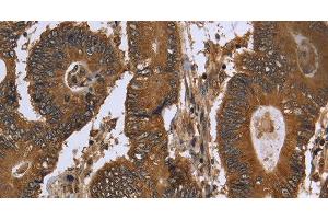 Immunohistochemistry of paraffin-embedded Human colon cancer using FGFRL1 Polyclonal Antibody at dilution of 1:40 (FGFRL1 antibody)