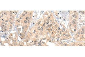 Immunohistochemistry of paraffin-embedded Human esophagus cancer tissue using HIPK2 Polyclonal Antibody at dilution of 1:40(x200) (HIPK2 antibody)