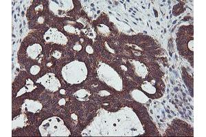 Immunohistochemical staining of paraffin-embedded Adenocarcinoma of Human colon tissue using anti-PDRG1 mouse monoclonal antibody. (PDRG1 antibody)