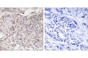 Peptide - +Immunohistochemistry analysis of paraffin-embedded human breast carcinoma tissue using GPRIN3 antibody.