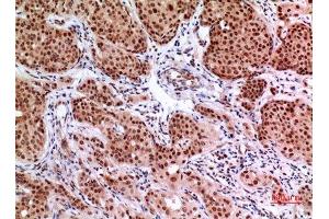 Immunohistochemistry (IHC) analysis of paraffin-embedded Human Mammary Cancer, antibody was diluted at 1:100. (EPAS1 antibody  (Ser343))