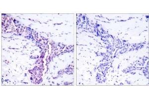 Immunohistochemical analysis of paraffin-embedded human breast carcinoma tissue using ATF-2 (Ab-73 or 55) antibody (E021032). (ATF2 antibody)