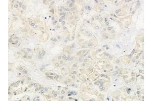 ABIN6263370 and ABIN6279022 at 1/100 staining human renal cell carcinoma by IHC-P.