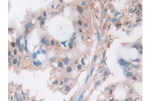 Detection of CFL1 in Human Bile duct cancer Tissue using Polyclonal Antibody to Cofilin 1 (CFL1) (Cofilin antibody  (AA 3-161))