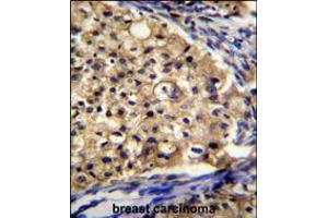 SLC16A13 Antibody immunohistochemistry analysis in formalin fixed and paraffin embedded human breast carcinoma followed by peroxidase conjugation of the secondary antibody and DAB staining. (SLC16A13 antibody  (C-Term))