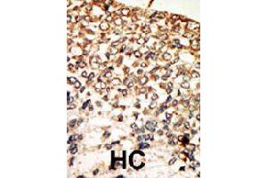 Formalin-fixed and paraffin-embedded human hepatocellular carcinoma tissue reacted with PRKACA polyclonal antibody  , which was peroxidase-conjugated to the secondary antibody, followed by AEC staining . (PRKACA antibody  (N-Term))