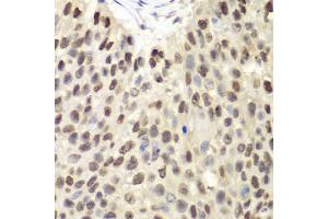 Immunohistochemistry of paraffin-embedded human lung cancer using MCM6 antibody.