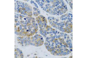 Immunohistochemistry of paraffin-embedded Human esophageal cancer using MBL2 antibody (ABIN6132334, ABIN6143597, ABIN6143600 and ABIN6221519) at dilution of 1:100 (40x lens). (MBL2 antibody  (AA 21-248))