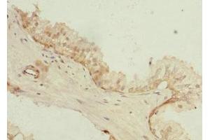 Immunohistochemistry of paraffin-embedded human prostate cancer using ABIN7163670 at dilution of 1:100 (PHLDA2 antibody  (AA 1-152))