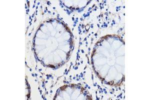 Immunohistochemistry of paraffin-embedded human colon carcinoma using GCAT antibody (ABIN7267461) at dilution of 1:100 (40x lens). (GCAT antibody  (AA 170-419))