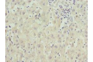 Immunohistochemistry of paraffin-embedded human liver cancer using ABIN7176363 at dilution of 1:100 (ZNF544 antibody  (AA 1-230))