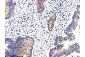 ABIN7094680 and ABIN7098731 at 1/100 staining Human colorectal cancer by IHC-P. (CLCA1 antibody  (C-Term))