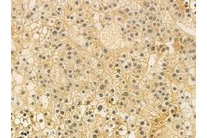 ABIN6259556 and ABIN6274915 at 1/100 staining human hepatocellular carcinoma by IHC-P. (GUSBP2 antibody  (Internal Region))