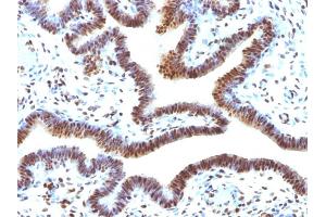 Formalin-fixed, paraffin-embedded human Ovarian Carcinoma stained with SUMO-2 Monoclonal Antibody (SUMO2/1199) (SUMO2 antibody)
