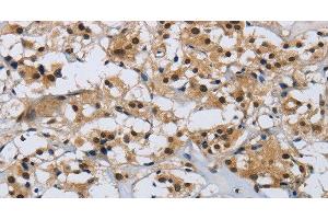 Immunohistochemistry of paraffin-embedded Human thyroid cancer tissue using CMTM8 Polyclonal Antibody at dilution 1:40
