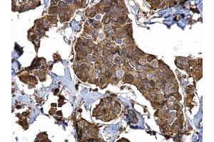 IHC-P Image Stathmin 1 antibody detects Stathmin 1 protein at cytosol on human breast carcinoma by immunohistochemical analysis. (Stathmin 1 antibody  (C-Term))