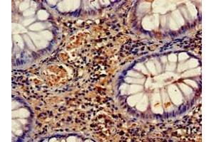Immunohistochemistry of paraffin-embedded human colon cancer using ABIN7158660 at dilution of 1:100 (HELLS antibody  (AA 550-600))