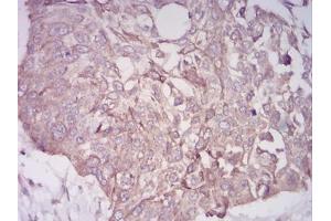 Immunohistochemical analysis of paraffin-embedded esophageal cancer tissues using BMP7 mouse mAb with DAB staining.
