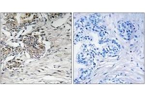 Immunohistochemistry analysis of paraffin-embedded human prostate carcinoma tissue, using Claudin 7 (Ab-210) Antibody. (Claudin 7 antibody  (AA 162-211))