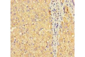 Immunohistochemistry of paraffin-embedded human liver cancer using ABIN7159675 at dilution of 1:100 (METTL7A antibody  (AA 30-244))