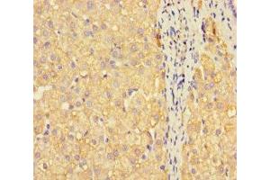 Immunohistochemistry of paraffin-embedded human liver cancer using ABIN7159675 at dilution of 1:100