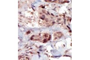 Formalin-fixed and paraffin-embedded human cancer tissue (breast carcinoma) reacted with the primary antibody, which was peroxidase-conjugated to the secondary antibody, followed by AEC staining. (SPHK2 antibody  (C-Term))