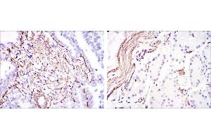 Immunohistochemical analysis of paraffin-embedded stomach cancer (left) and stomach tissues (right) using ACTA2 mouse mAb with DAB staining. (Smooth Muscle Actin antibody)