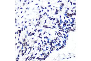 Immunohistochemistry of paraffin-embedded human esophageal cancer using POU2F1/POU2F1/OCT1 Rabbit mAb (ABIN7269495) at dilution of 1:100 (40x lens). (POU2F1 antibody)