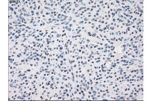 Immunohistochemical staining of paraffin-embedded Carcinoma of thyroid tissue using anti-FCGR2A mouse monoclonal antibody. (FCGR2A antibody)
