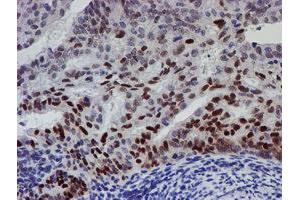 Immunohistochemical staining of paraffin-embedded Adenocarcinoma of Human endometrium tissue using anti-UBE2E3 mouse monoclonal antibody. (UBE2E3 antibody)