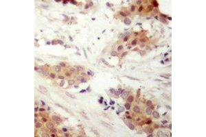 Immunohistochemical analysis of Cyclin D3 (pT283) staining in human breast cancer formalin fixed paraffin embedded tissue section. (Cyclin D3 antibody  (C-Term, pSer283))