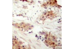 Immunohistochemical analysis of Cyclin D3 (pT283) staining in human breast cancer formalin fixed paraffin embedded tissue section.