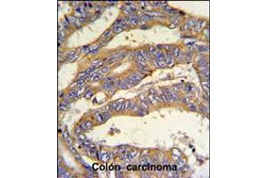 RSAD1 Antibody IHC analysis in formalin fixed and paraffin embedded human colon carcinoma followed by peroxidase conjugation of the secondary antibody and DAB staining. (RSAD1 antibody  (C-Term))