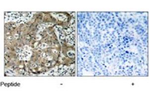 Immunohistochemical analysis of paraffin-embedded human breast carcinoma tissue using FOXO1 polyclonal antibody  . (FOXO1 antibody)