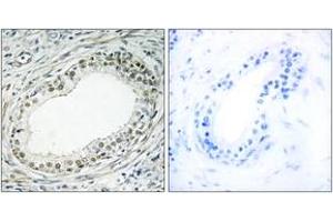 Immunohistochemistry analysis of paraffin-embedded human prostate carcinoma tissue, using RPL36 Antibody. (RPL36 antibody  (AA 51-100))