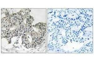 Immunohistochemistry analysis of paraffin-embedded human breast carcinoma tissue using PXMP3 antibody.